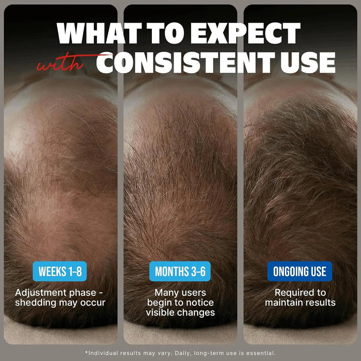 Kirkland Signature Minoxidil 5% Topical Solution for Men (Caja 6 unidades) Magic Mechas